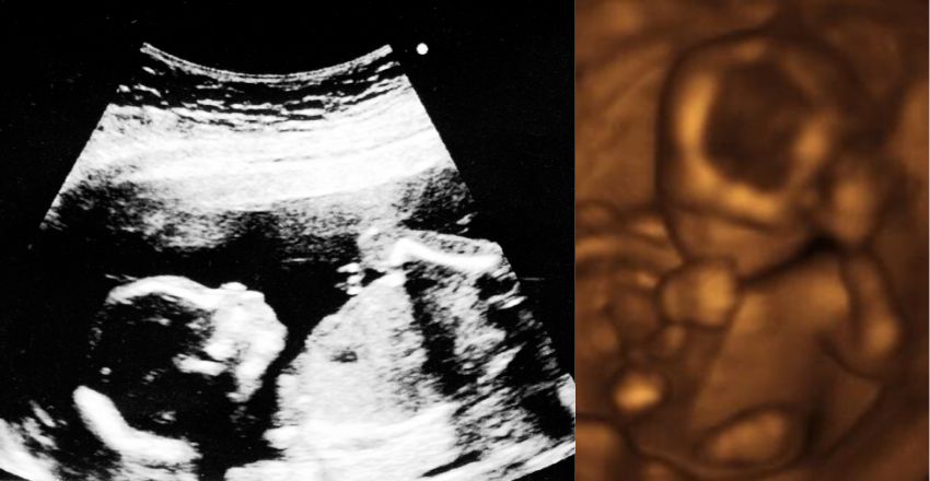 what baby looks like in pregnancy week 17 ultrascan