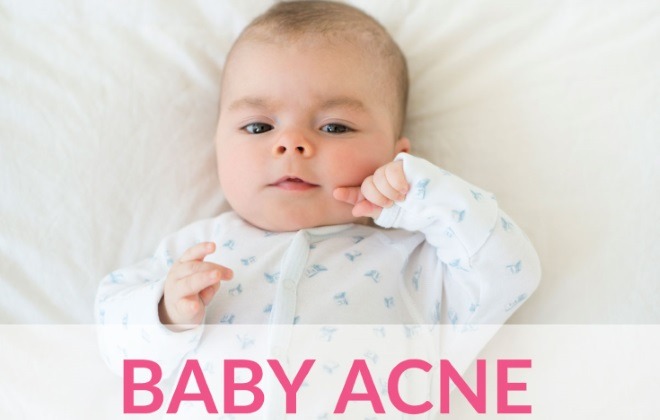 baby acne causes