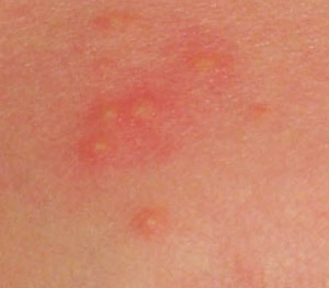 neonatal baby acne typical