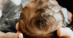 Read more about the article Baby Cradle Cap: Symptoms, Causes, Treatments, FAQ