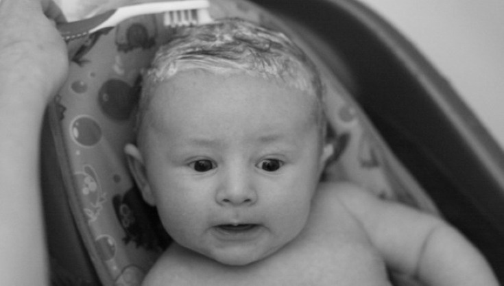 baby losing hair due to cradle cap