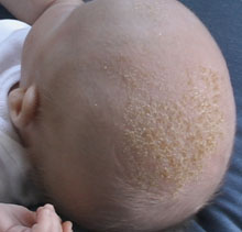 how to get rid of cradle cap