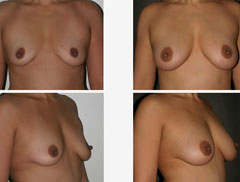 breast fat grafting