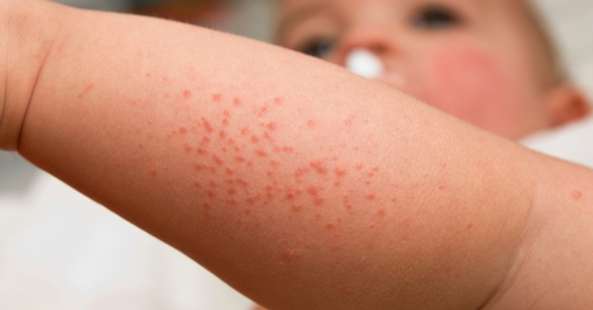 bumps on baby's face and legs