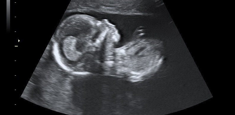 fetus in week 16 ultrasound