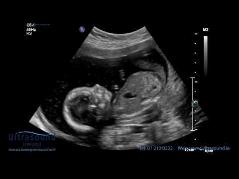 Scan of the Week: 18 Week Advanced Early Scan