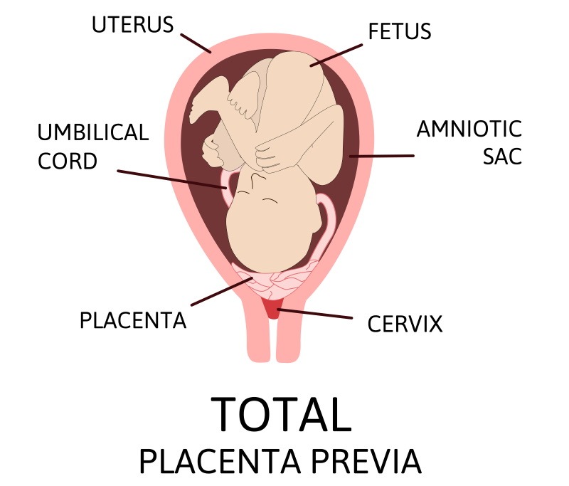 placenta previa pregnancy bleeding