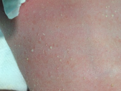 Transient Neonatal Pustular Melanosis