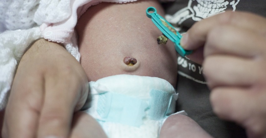 umbilical cord stump falls off