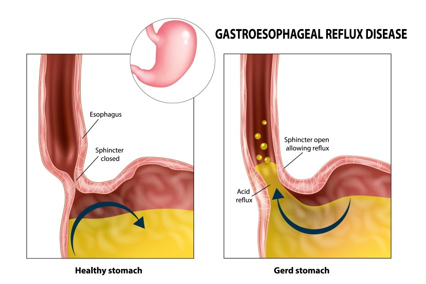 what is acid reflux in babies and toddlers