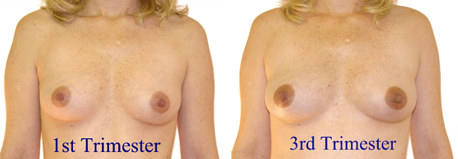 areola changes during pregnancy