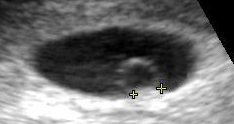 Ultrasound of embryo at 5 weeks pregnant